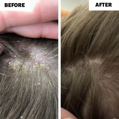 ScalpHero™ - Shampoo Brush